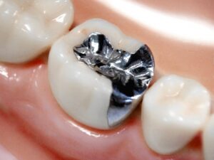 【悲報】銀歯の虫歯再発率、ヤバ過ぎるｗｗｗｗｗｗｗｗｗ
