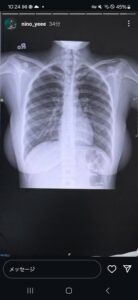 【画像】地味系爆乳のレントゲン写真