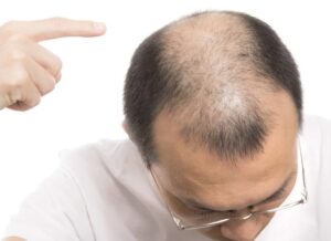 カリスマ美容師、『ただのハゲ』を『痛いハゲ』に昇格させてしまうwww