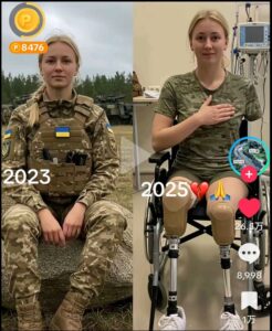【画像あり】ウクライナ人美女兵士、次々と手足を失う