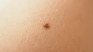 【画像】脚に癌みたいなのできたｗｗｗ → ヤバすぎる事実が発覚しスレ騒然