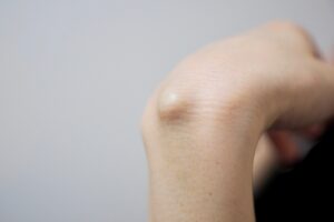 【緊急】腕に謎のしこりができて強すぎるんだけど助けて