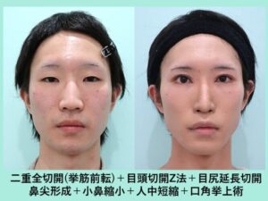 【画像】男の鼻整形、最強だと判明